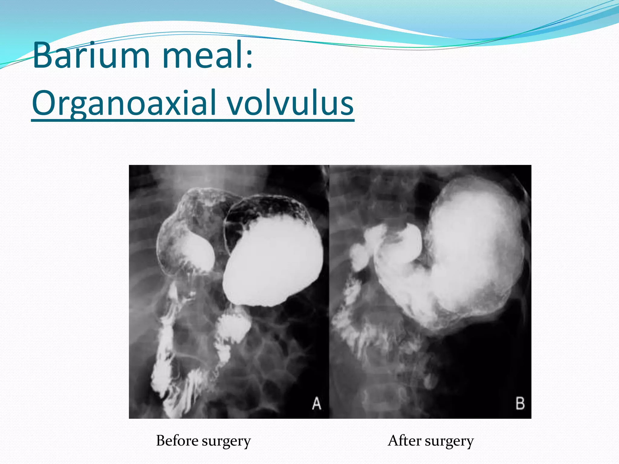 Barium meal:
Organoaxial volvulus

Before surgery

After surgery

 