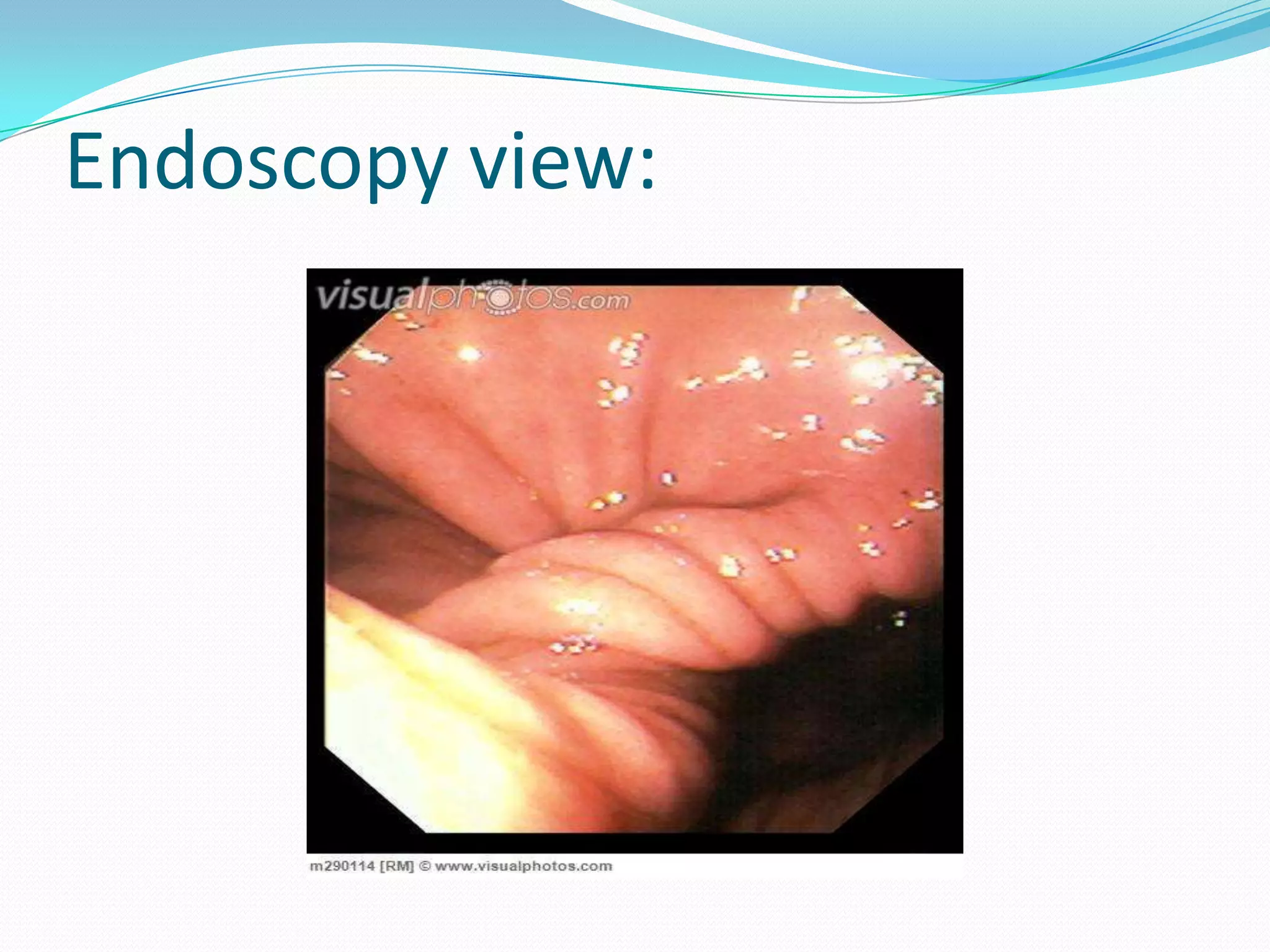 Endoscopy view:

 
