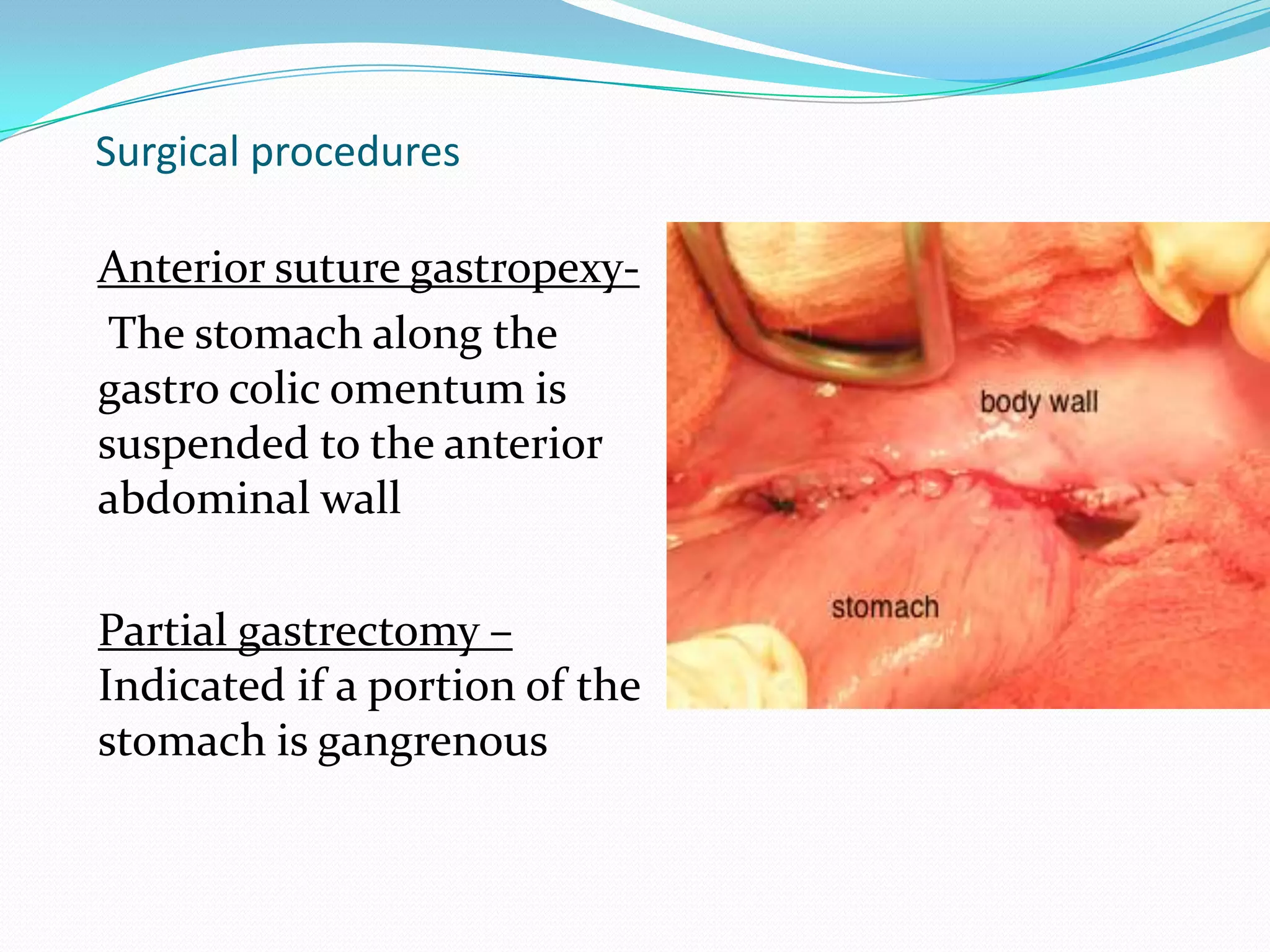 Surgical procedures
Anterior suture gastropexyThe stomach along the
gastro colic omentum is
suspended to the anterior
abdominal wall
Partial gastrectomy –
Indicated if a portion of the
stomach is gangrenous

 
