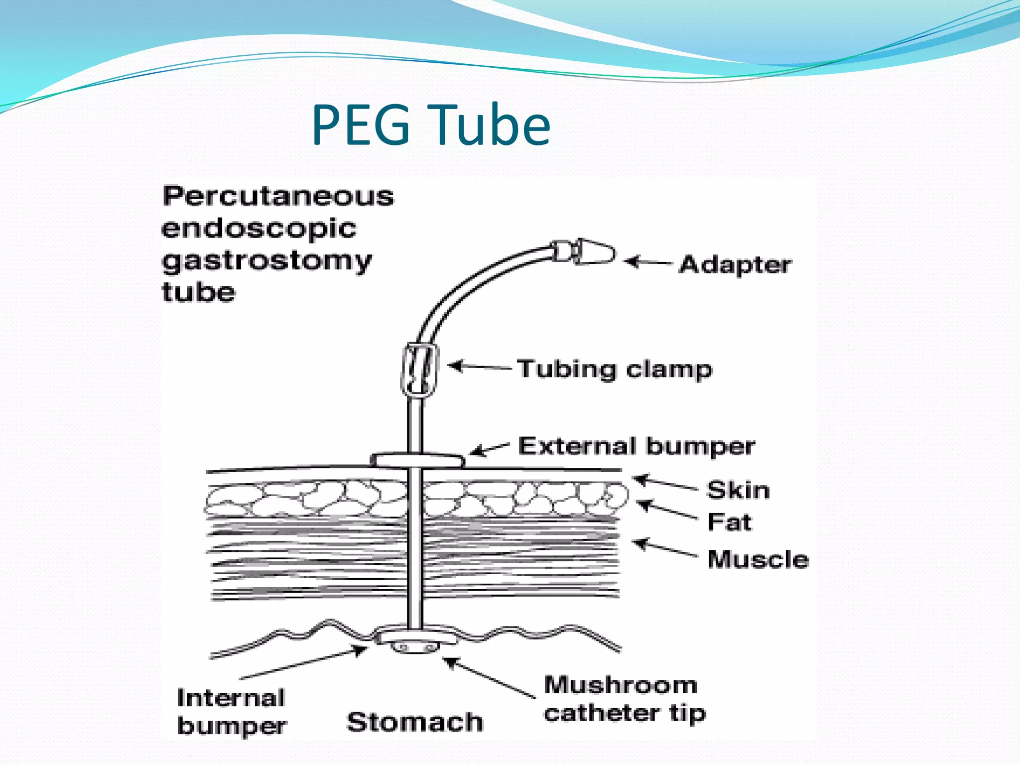 PEG Tube

 