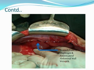 Gastric volvulus and other types of volvulus | PPTX