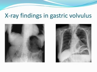 Volvulus X Ray Volvulus X Ray