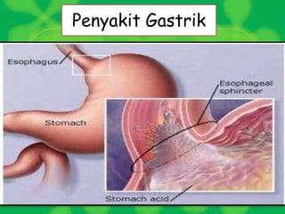 Penyakit Gastrik
 