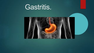 Gastritis.
 