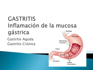 GASTRITIS Inflamación de la mucosa gástrica Gastritis Aguda  Gastritis Crónica 