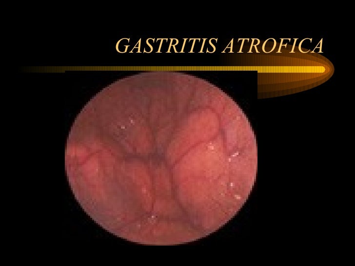 Gastritis