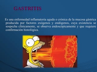 Es una enfermedad inflamatoria aguda o crónica de la mucosa gástrica
producida por factores exógenos y endógenos, cuya existencia se
sospecha clínicamente, se observa endoscópicamente y que requiere
confirmación histológica.
 
