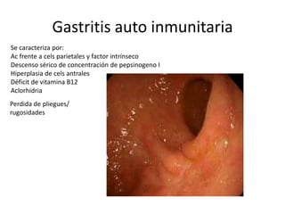 Gastritis auto inmunitaria
Se caracteriza por:
Ac frente a cels parietales y factor intrínseco
Descenso sérico de concentración de pepsinogeno I
Hiperplasia de cels antrales
Déficit de vitamina B12
Aclorhidria
Perdida de pliegues/
rugosidades
 