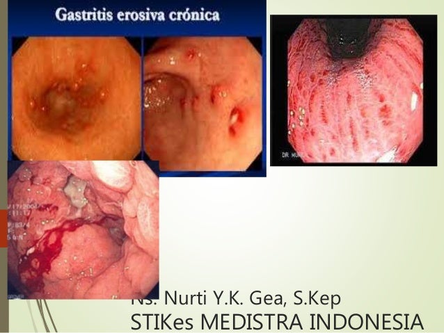 Gastritis después de erradicar helicobacter