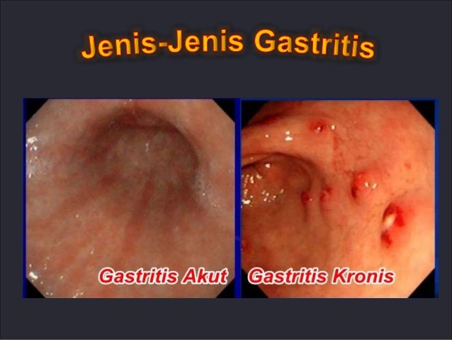 Gastritis por antibióticos