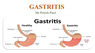 GASTRITIS
Mr Pritesh Patel
 