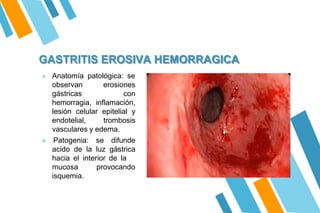 GASTRITIS EROSIVA HEMORRAGICA
» Anatomía patológica: se
observan
gástricas
erosiones
con
hemorragia, inflamación,
lesión celular epitelial y
endotelial, trombosis
vasculares y edema.
» Patogenia: se difunde
acido de la luz gástrica
hacia el interior de la
provocando
mucosa
isquemia.
 