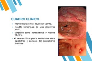 CUADRO CLINICO
» Plenitud epigástrica, nauseas y vomito.
» Posible hemorragia de vías digestivas
altas
» Sangrado como hematemesis y melena
10-12%
» Al examen físico puede encontrarse dolor
epigástrico y aumento del peristaltismo
intestinal
 
