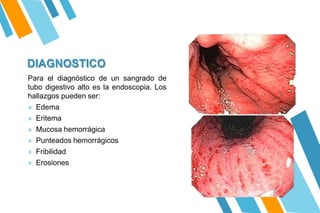DIAGNOSTICO
Para el diagnóstico de un sangrado de
tubo digestivo alto es la endoscopia. Los
hallazgos pueden ser:
» Edema
» Eritema
» Mucosa hemorrágica
» Punteados hemorrágicos
» Fribilidad
» Erosiones
 