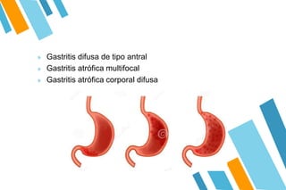 » Gastritis difusa de tipo antral
» Gastritis atrófica multifocal
» Gastritis atrófica corporal difusa
 
