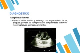 DIAGNOSTICO
Ecografía abdominal
» Evidencia ascitis mínima y estomago con engrosamiento de los
pliegues gástricos. La tomografía axial computarizada abdominal
muestra pliegues gástricos prominentes.
 