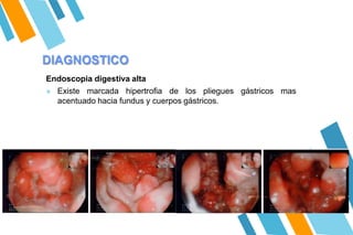 DIAGNOSTICO
Endoscopia digestiva alta
» Existe marcada hipertrofia de los pliegues gástricos mas
acentuado hacia fundus y cuerpos gástricos.
 