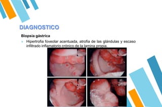 DIAGNOSTICO
Biopsia gástrica
» Hipertrofia foveolar acentuada, atrofia de las glándulas y escaso
infiltrado inflamatorio crónico de la lamina propia.
 