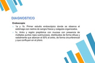 DIAGNOSTICO
Endoscopia:
» 1a y 1b. Primer estudio endoscópico donde se observa el
estómago con rastros de sangre fresca y coágulos organizados.
» 1c. Antro y región prepilórica con mucosa con presencia de
múltiples puntos rojos submucosos, distribuidos de forma difusa y
radialmente que abarcan el 50% el antro, de forma circunferencial
y que confluyen en el píloro.
 