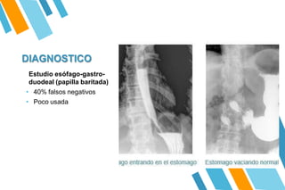 DIAGNOSTICO
Estudio esófago-gastro-
duodeal (papilla baritada)
• 40% falsos negativos
• Poco usada
 
