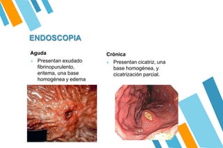 ENDOSCOPIA
Aguda
» Presentan exudado
fibrinopurulento,
eritema, una base
homogénea y edema
Crónica
» Presentan cicatriz, una
base homogénea, y
cicatrización parcial.
 