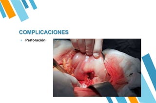 COMPLICACIONES
» Perforación
 