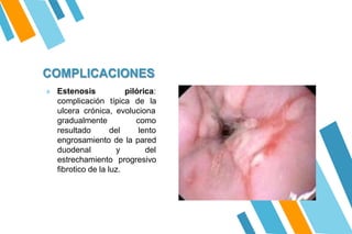 COMPLICACIONES
» Estenosis pilórica:
complicación típica de la
ulcera crónica, evoluciona
gradualmente
resultado del
como
lento
engrosamiento de la pared
duodenal y del
estrechamiento progresivo
fibrotico de la luz.
 