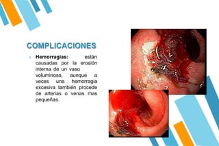 COMPLICACIONES
» Hemorragias: están
causadas por la erosión
interna de un vaso
voluminoso, aunque a
veces una hemorragia
excesiva también procede
de arterias o venas mas
pequeñas.
 