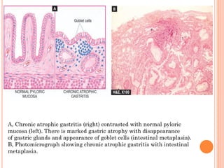 A, Chronic atrophic gastritis (right) contrasted with normal pyloric
mucosa (left). There is marked gastric atrophy with disappearance
of gastric glands and appearance of goblet cells (intestinal metaplasia).
B, Photomicrograph showing chronic atrophic gastritis with intestinal
metaplasia.
 