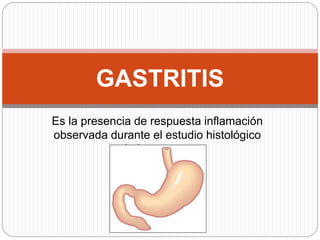 Es la presencia de respuesta inflamación
observada durante el estudio histológico
de la mucosa.
GASTRITIS
 