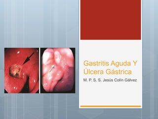 Gastritis Aguda Y
Úlcera Gástrica
M. P. S. S. Jesús Colín Gálvez
 