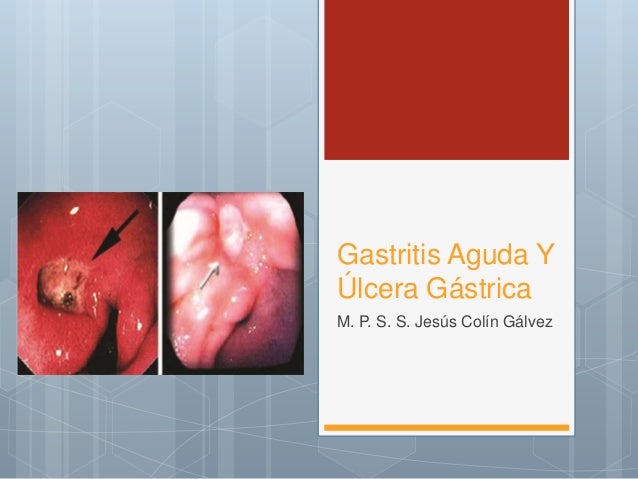 sintomas de gastritis y ulcera gastrica
