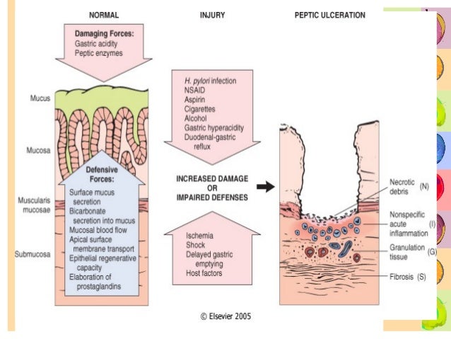 Gastritis erosiva