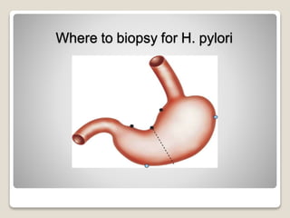 Where to biopsy for H. pylori
 