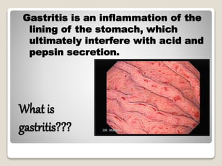 What is
gastritis???
Gastritis is an inflammation of the
lining of the stomach, which
ultimately interfere with acid and
pepsin secretion.
 