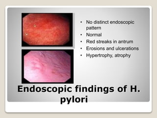 Endoscopic findings of H.
pylori
• No distinct endoscopic
pattern
• Normal
• Red streaks in antrum
• Erosions and ulcerations
• Hypertrophy, atrophy
 