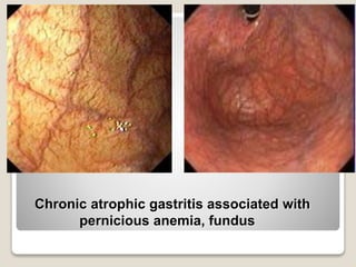 Chronic atrophic gastritis associated with
pernicious anemia, fundus
 