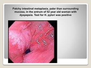 Patchy intestinal metaplasia, paler than surrounding
mucosa, in the antrum of 52 year old woman with
dyspepsia. Test for H. pylori was positive
 