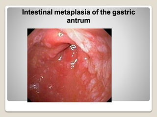 Intestinal metaplasia of the gastric
antrum
 