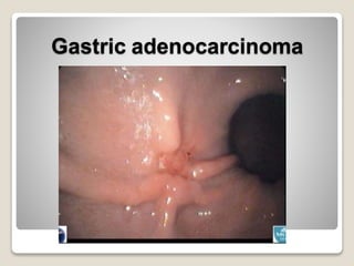 Gastric adenocarcinoma
 