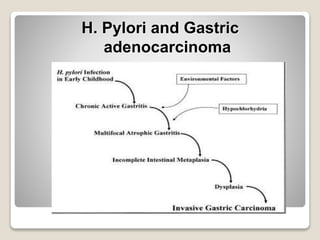 H. Pylori and Gastric
adenocarcinoma
 