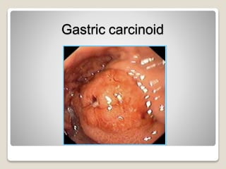 Gastric carcinoid
 