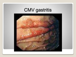 CMV gastritis
 