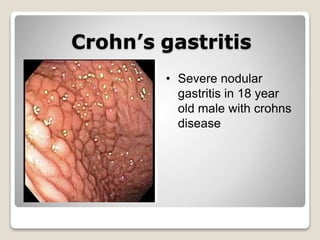 Crohn’s gastritis
• Severe nodular
gastritis in 18 year
old male with crohns
disease
 