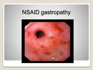 NSAID gastropathy
 