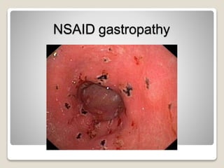 NSAID gastropathy
 
