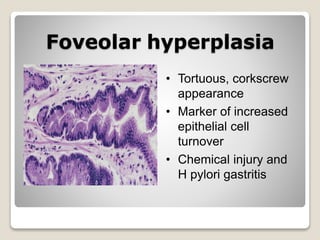 Foveolar hyperplasia
• Tortuous, corkscrew
appearance
• Marker of increased
epithelial cell
turnover
• Chemical injury and
H pylori gastritis
 