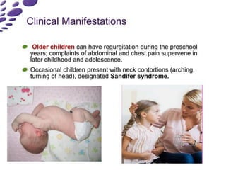 Sandifer Reflex gastro-esophageal-reflux-disease-gerd-in-children (1)_OCR.pdf