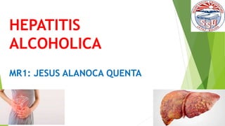 HEPATITIS
ALCOHOLICA
MR1: JESUS ALANOCA QUENTA
 
