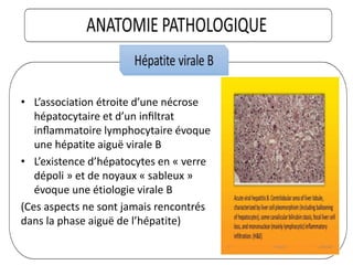 • L’association étroite d’une nécrose
hépatocytaire et d’un inﬁltrat
inﬂammatoire lymphocytaire évoque
une hépatite aiguë virale B
• L’existence d’hépatocytes en « verre
dépoli » et de noyaux « sableux »
évoque une étiologie virale B
(Ces aspects ne sont jamais rencontrés
dans la phase aiguë de l’hépatite)
 